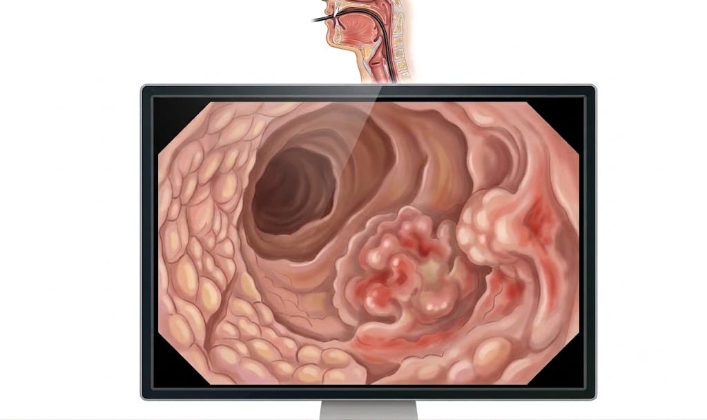 medicina funcional enfermedad de Crohn