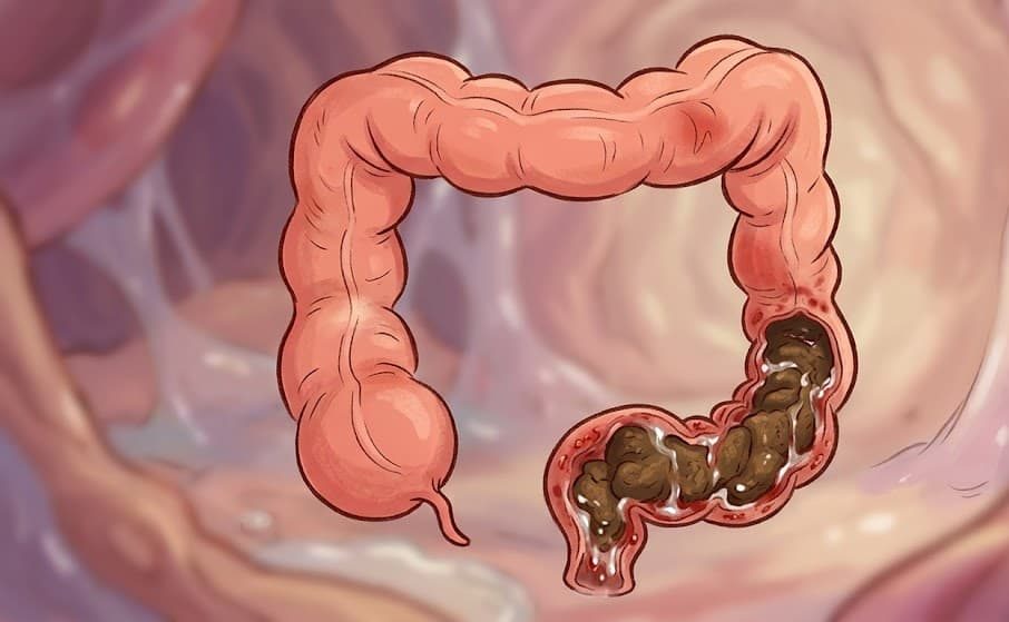 médico integrativo colitis ulcerosa